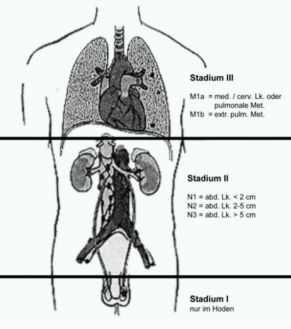 Tumorstadien Lugano Klassifikation 